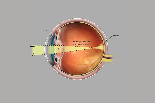 Các loại kính mắt được nhiều người lựa chọn tại TCI