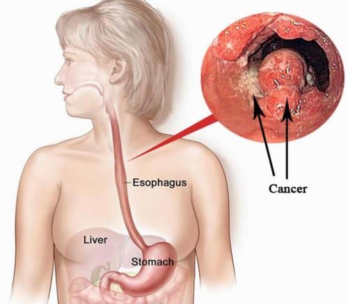 Các loại ung thư đường tiêu hóa