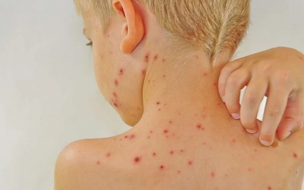 Các loại vắc xin rota virus đang được sử dụng hiện nay