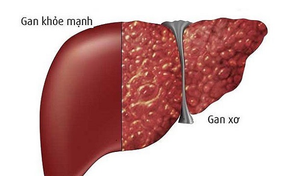 Các loại vắc xin viêm gan B phổ biến hiện nay