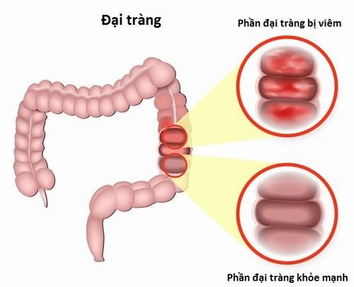 Các loại viêm đại tràng