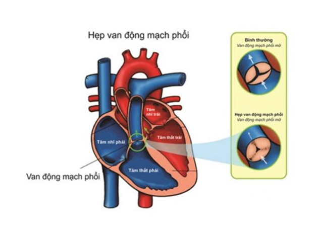 Các mức độ hẹp van động mạch phổi và cách điều trị