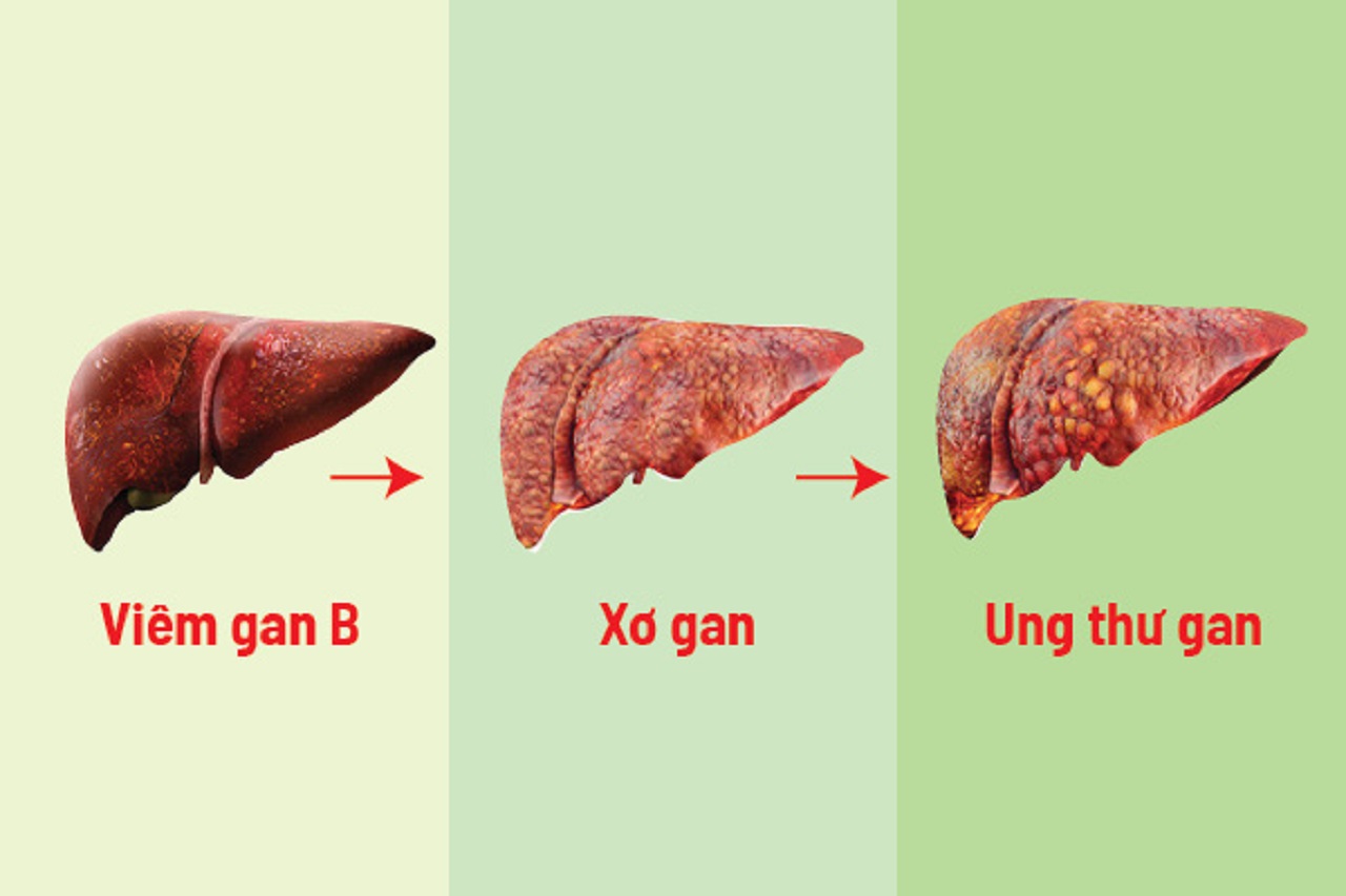 Các mũi tiêm ngừa viêm gan B cho trẻ em và người lớn