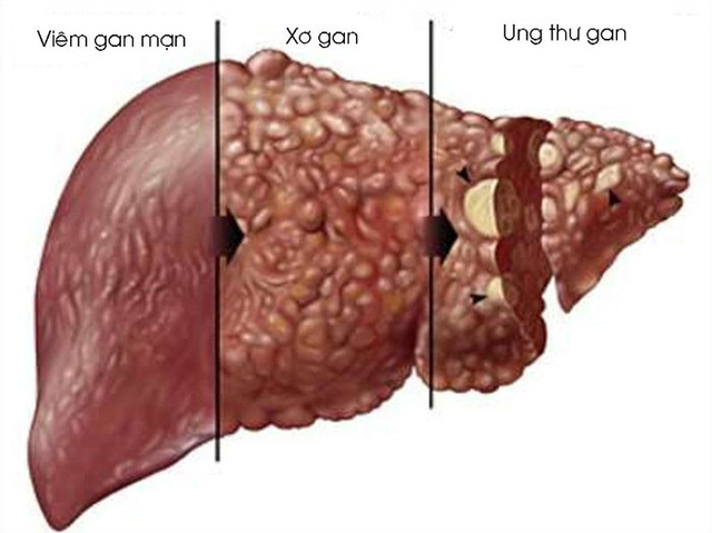 Các mũi tiêm phòng viêm gan B cho trẻ em và người lớn