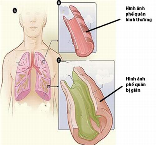 Các nguyên nhân gây giãn phế quản