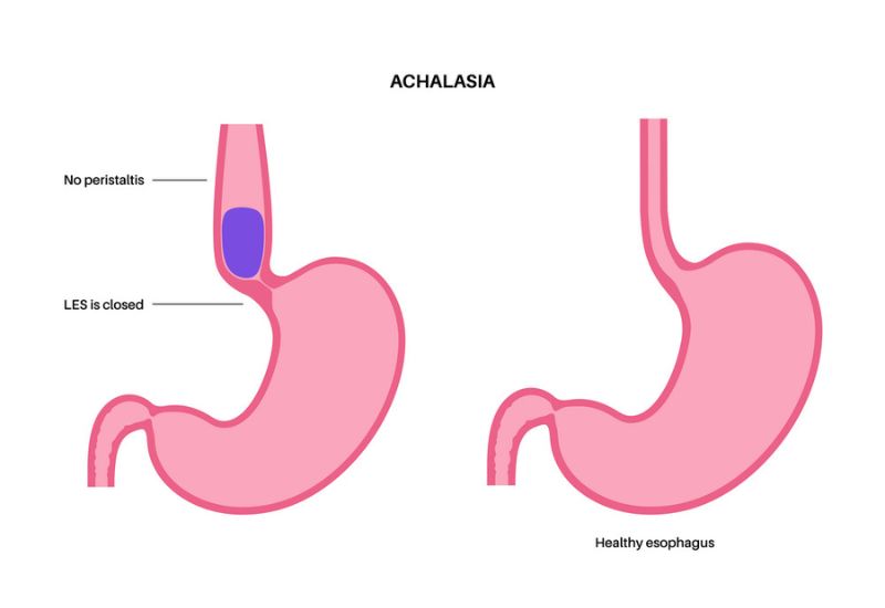 Các nguyên nhân gây xuất hiện nuốt vướng nuốt nghẹn