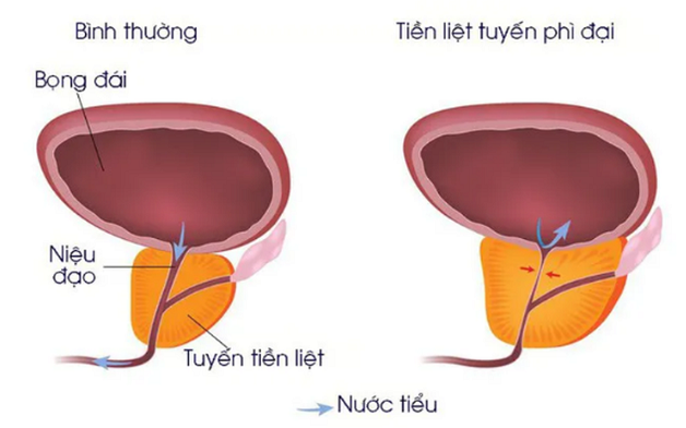 Các nguyên nhân sỏi bàng quang phổ biến nhất