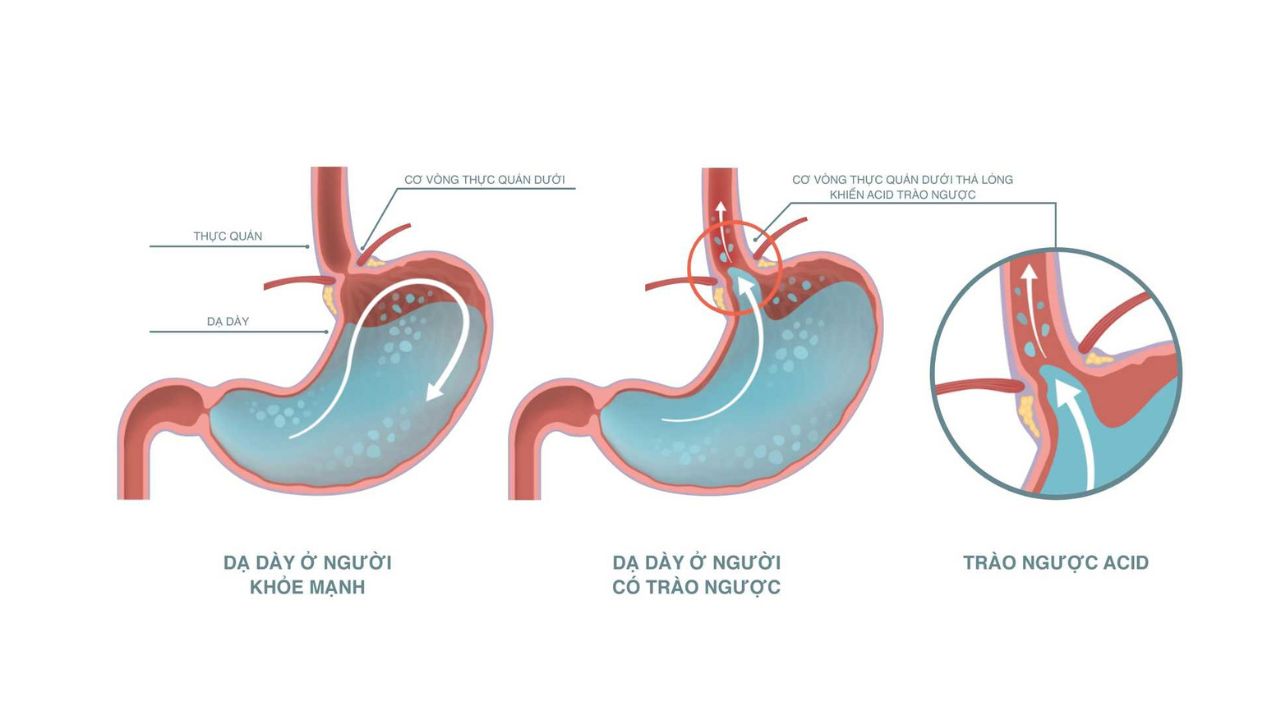 Các nguyên nhân trào ngược phổ biến và cách chẩn đoán