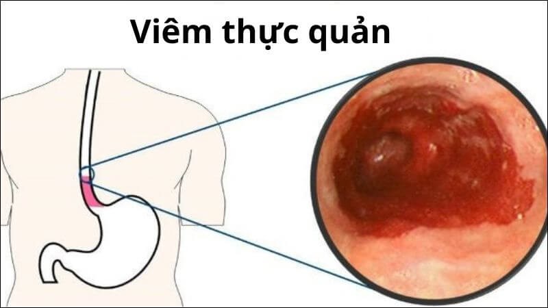 Các nguyên nhân trào ngược phổ biến và cách chẩn đoán