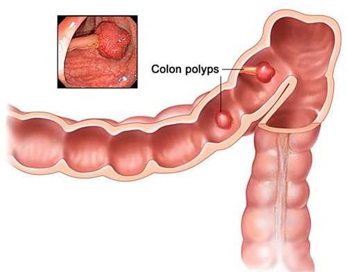 Các phương pháp cắt polyp đại tràng