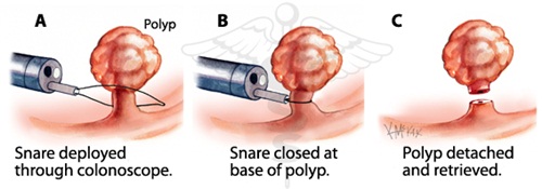 Các phương pháp cắt polyp đại tràng