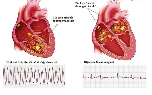 Các phương pháp chẩn đoán và điều trị rối loạn nhịp tim