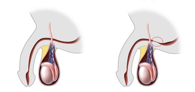 Các phương pháp điều trị hẹp niệu đạo sau hiện nay