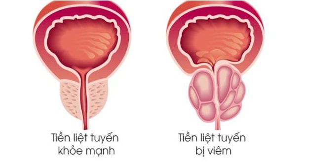 Các phương pháp điều trị hẹp niệu đạo sau hiện nay