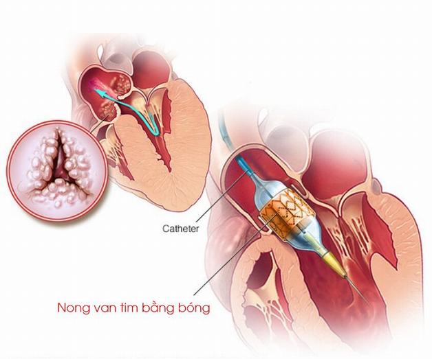 Các phương pháp điều trị hẹp van tim 2 lá