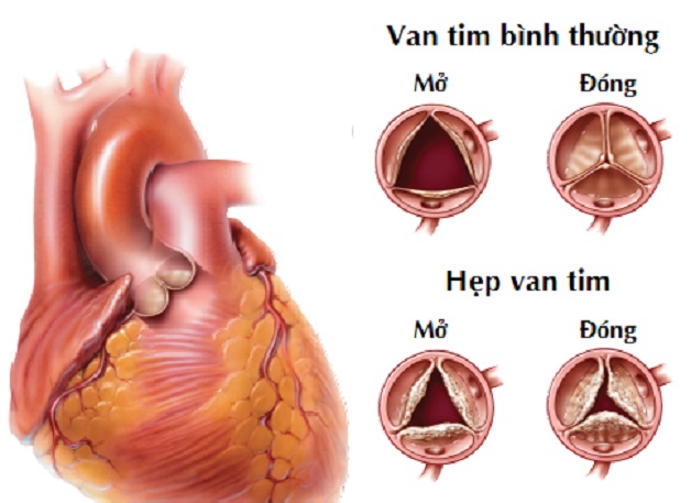 Các phương pháp điều trị hẹp van tim hiệu quả hiện nay