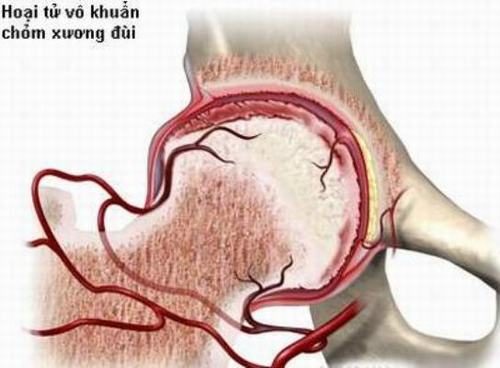 Các phương pháp điều trị hoại tử chỏm xương đùi