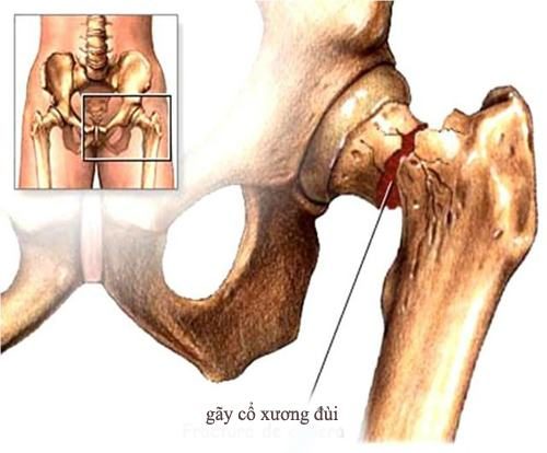 Các phương pháp điều trị hoại tử chỏm xương đùi