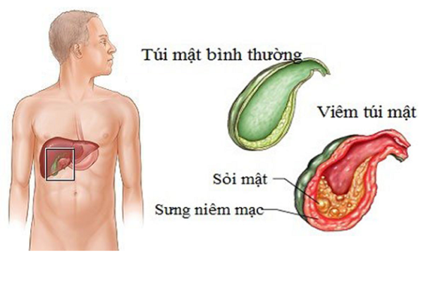 Các phương pháp điều trị sỏi mật tối ưu nhất hiện nay