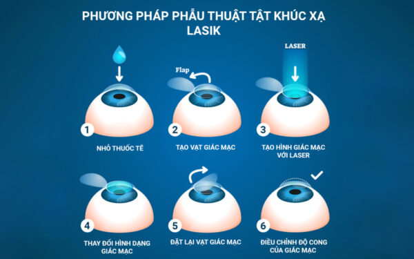 Các phương pháp điều trị tật khúc xạ bằng laser excimer