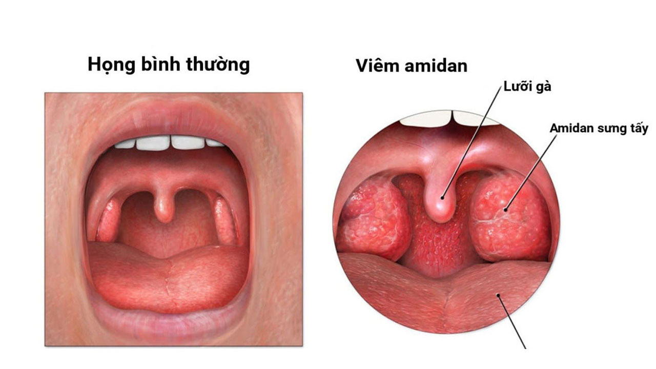 Các phương pháp điều trị viêm amidan phù hợp cho người bệnh