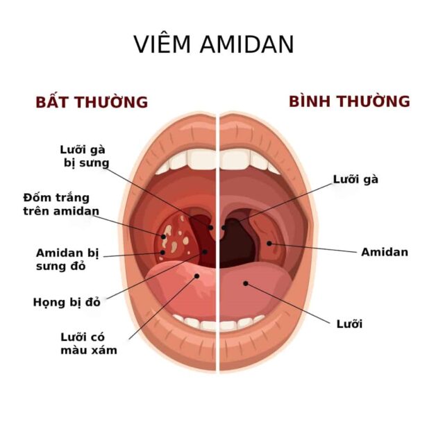 Các phương pháp điều trị viêm amidan phù hợp cho người bệnh