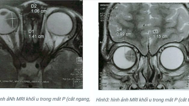 Các phương pháp khám u nguyên bào võng mạc