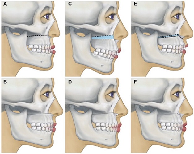 Các phương pháp nắn chỉnh răng hô phổ biến hiện nay 