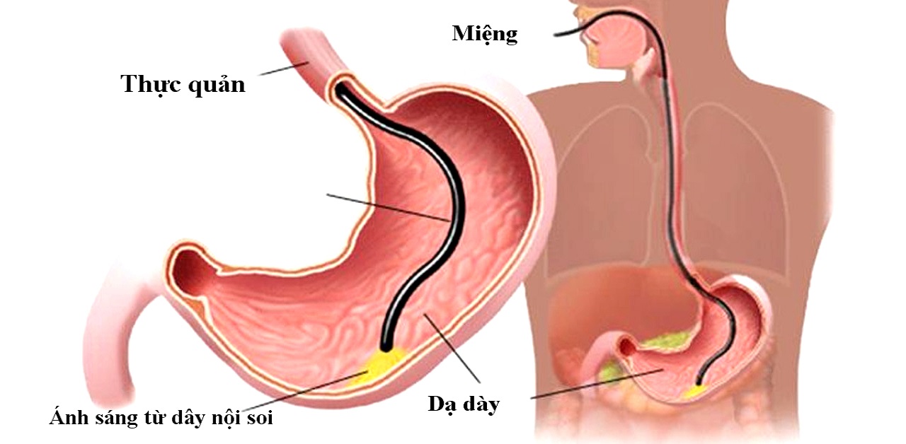 Các phương pháp nội soi không đau là gì?