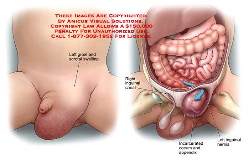 Các phương pháp phẫu thuật thoát vị bẹn