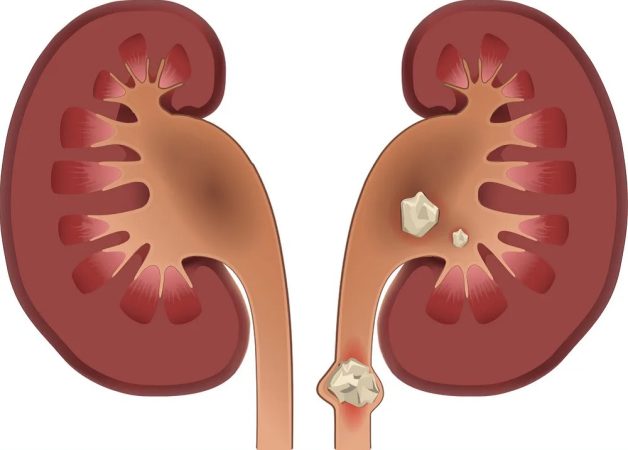 Các phương pháp tán sỏi đường tiết niệu phổ biến hiện nay