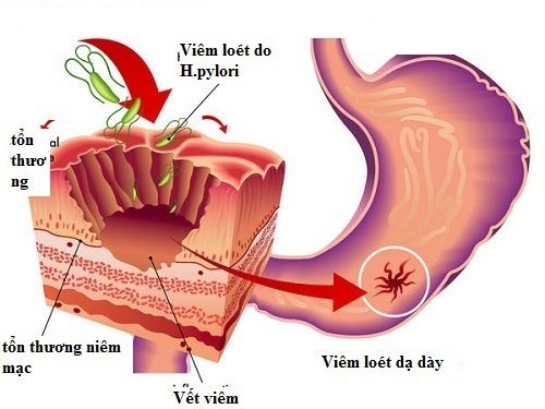 Các phương pháp xét nghiệm tìm HP