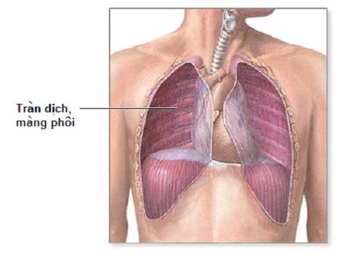 Các phương pháp xử lí tràn dịch màng phổi