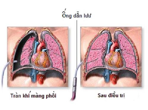 Các phương pháp xử lí tràn dịch màng phổi