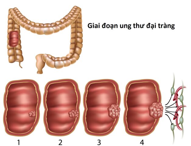 Các thông tin quan trọng về ung thư đại trực tràng