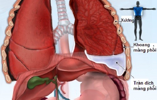 Các thực phẩm nên ăn khi tràn dịch màng phổi