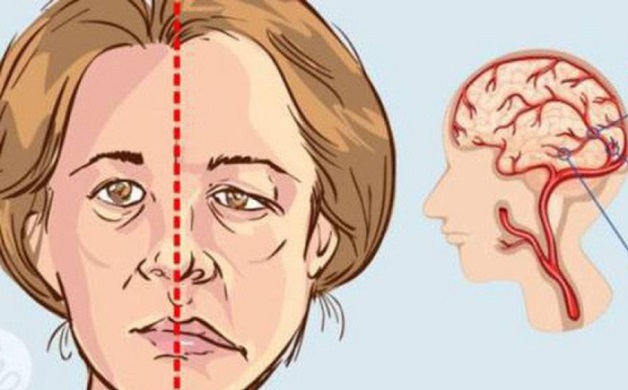 Các triệu chứng bệnh đột quỵ nào cảnh báo nguy hiểm?