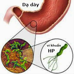 Các triệu chứng đau dạ dày có thể nhận biết sớm