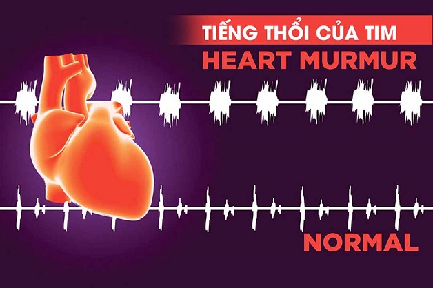 Các triệu chứng hẹp van tim không nên bỏ qua