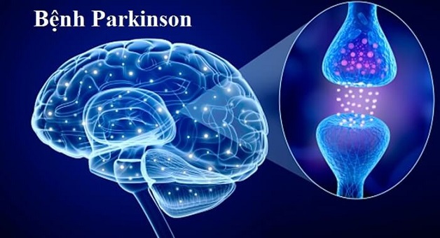 Các triệu chứng Parkinson ở giai đoạn sớm