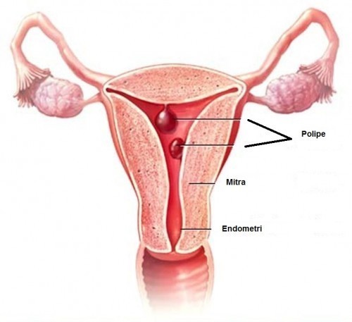 Các triệu chứng polyp tử cung những biến chứng không đáng có