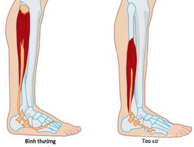 Các triệu chứng u tuyến thượng thận