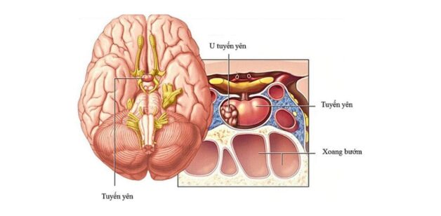 Các triệu chứng u tuyến yên