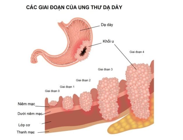 Các triệu chứng ung thư dạ dày không nên bỏ qua