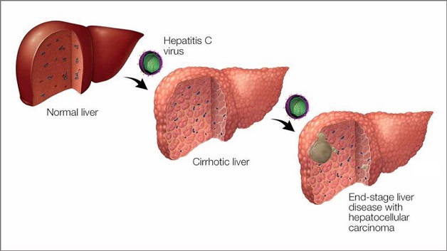 Các triệu chứng viêm gan C bạn không thể bỏ qua
