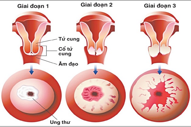 Các xét nghiệm ung thư cổ tử cung được sử dụng phổ biến