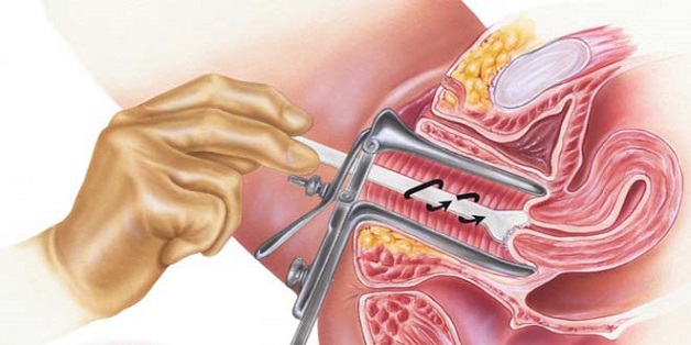 Các xét nghiệm ung thư cổ tử cung được sử dụng phổ biến