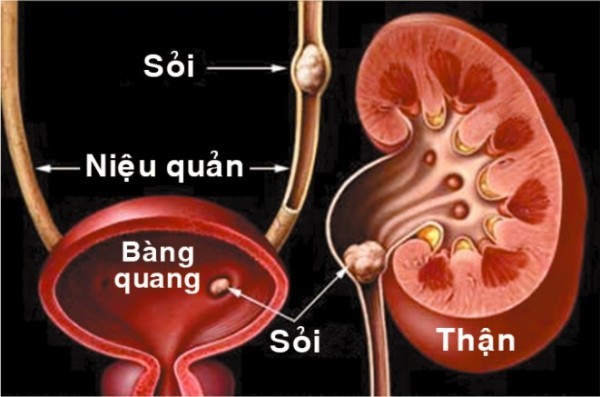 Các yếu tố nguy cơ của bệnh sỏi đường tiết niệu