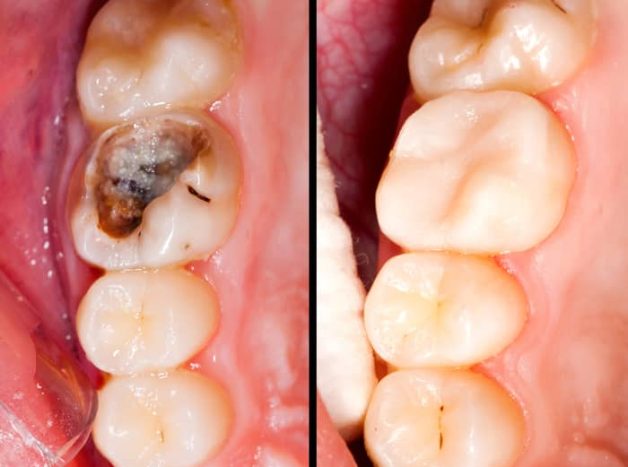 Cách chăm sóc răng sau hàn trám điều trị sâu