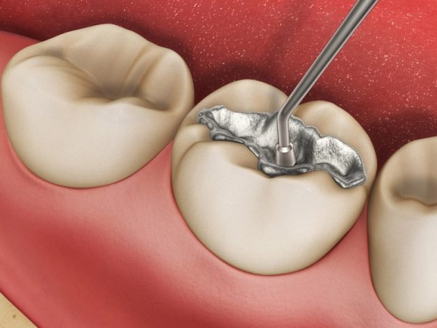 Cách chăm sóc răng sau hàn trám điều trị sâu